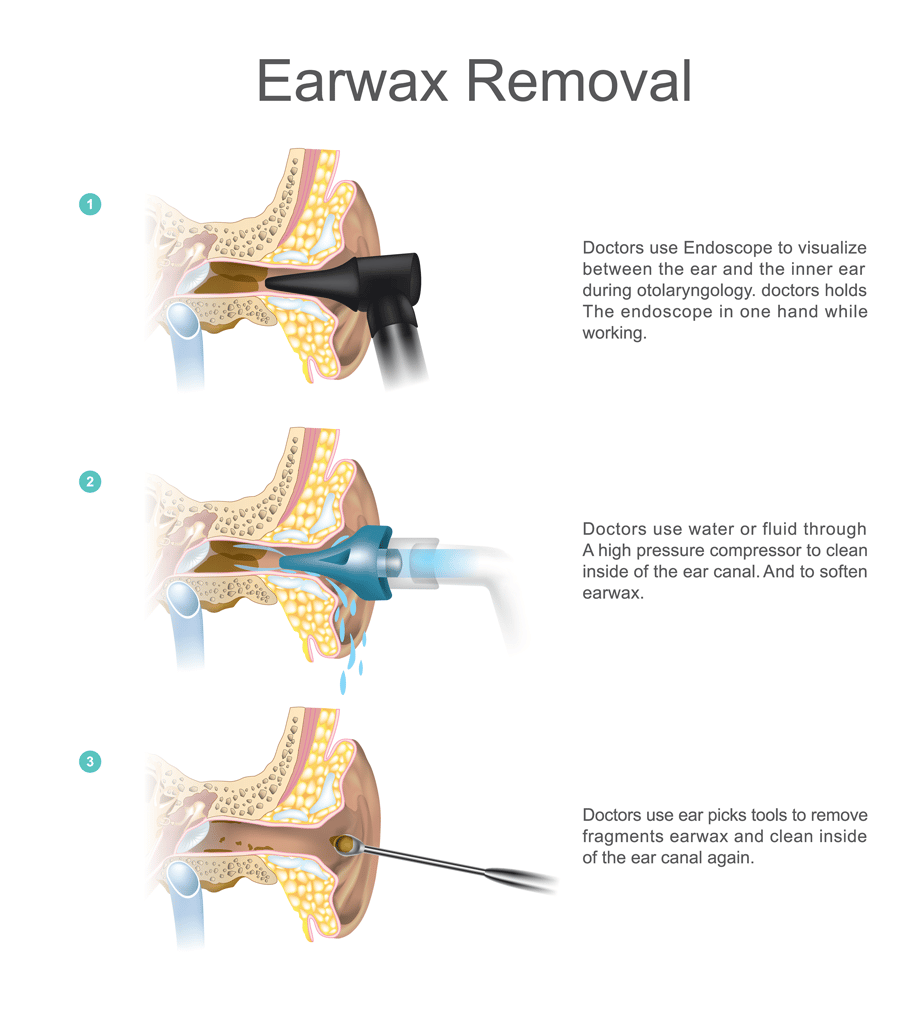 Earwax removal chart