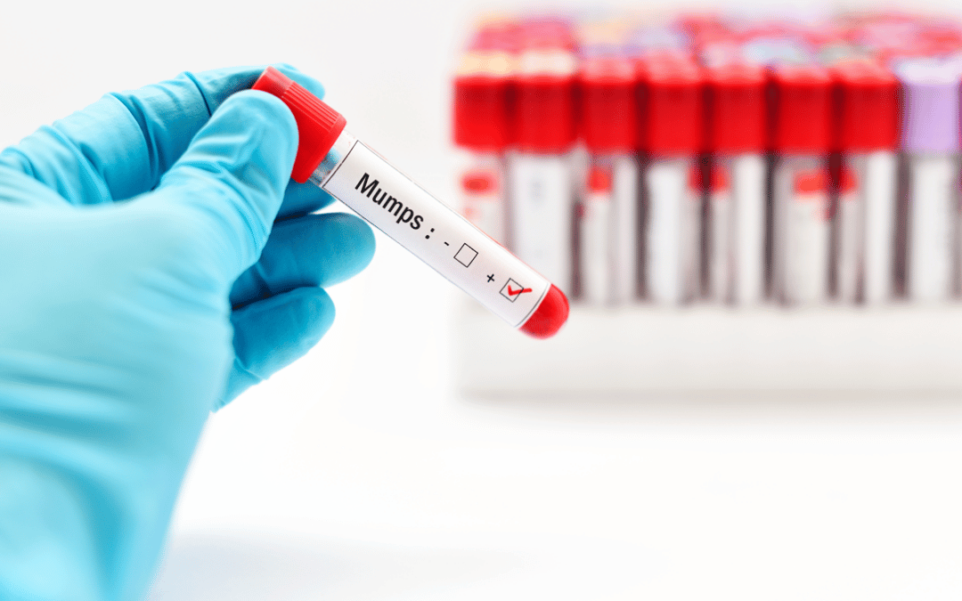 Mumps and Loss of Hearing